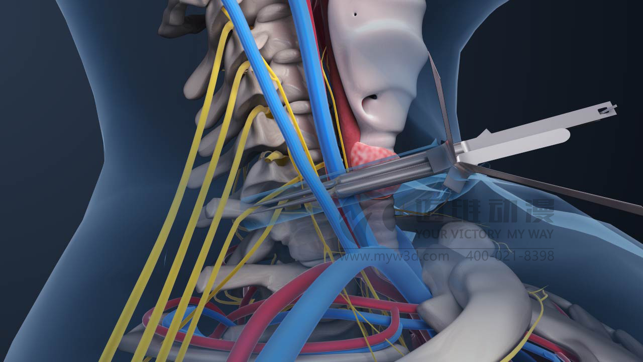 對(duì)于醫(yī)療三維動(dòng)畫(huà)你會(huì)怎么做？(圖2)