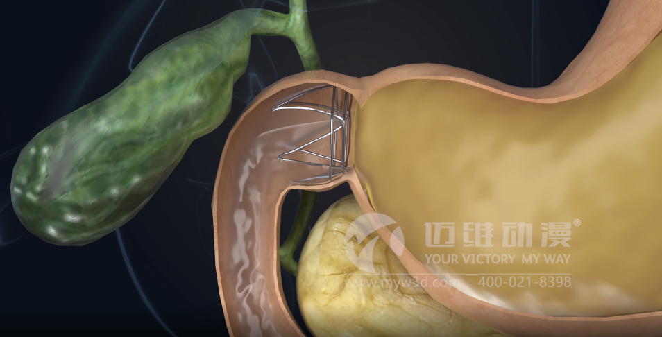 熱烈祝賀邁維動漫與杭州糖吉醫(yī)療科技有限公司圓滿完成胃轉(zhuǎn)流支架系統(tǒng)三維動畫項目合作！(圖3)